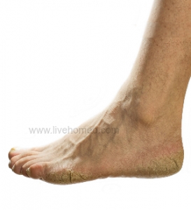 homeopathic remedy for foot cracks