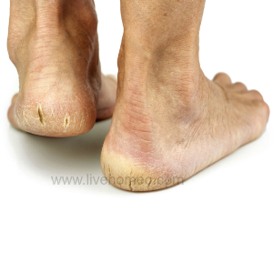 homeopathic remedy for foot cracks