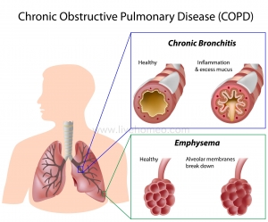 Homeopathy for Lung Disorders