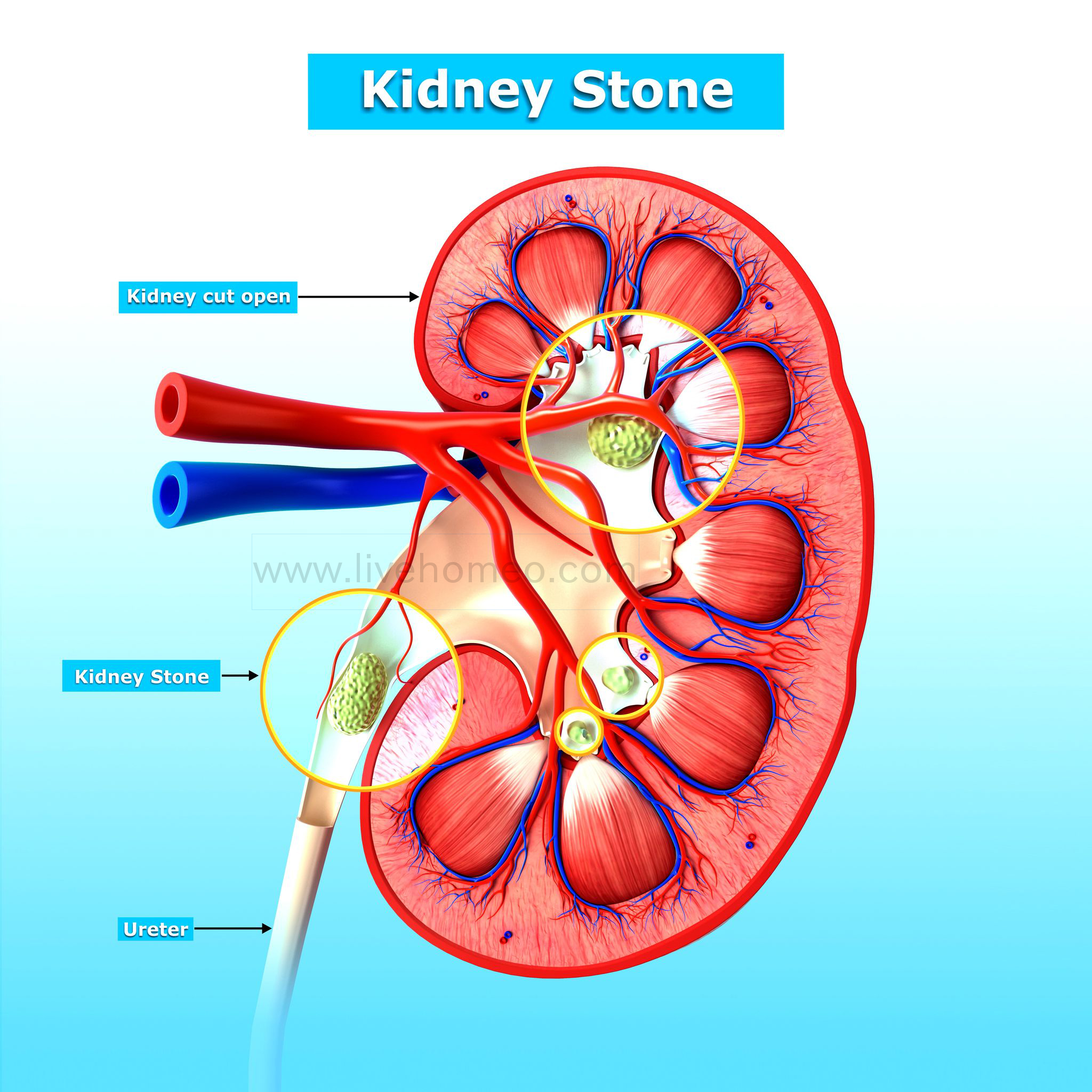 kidney Stone Disorders