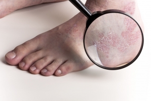 Homeopathy treatment for Psoriasis