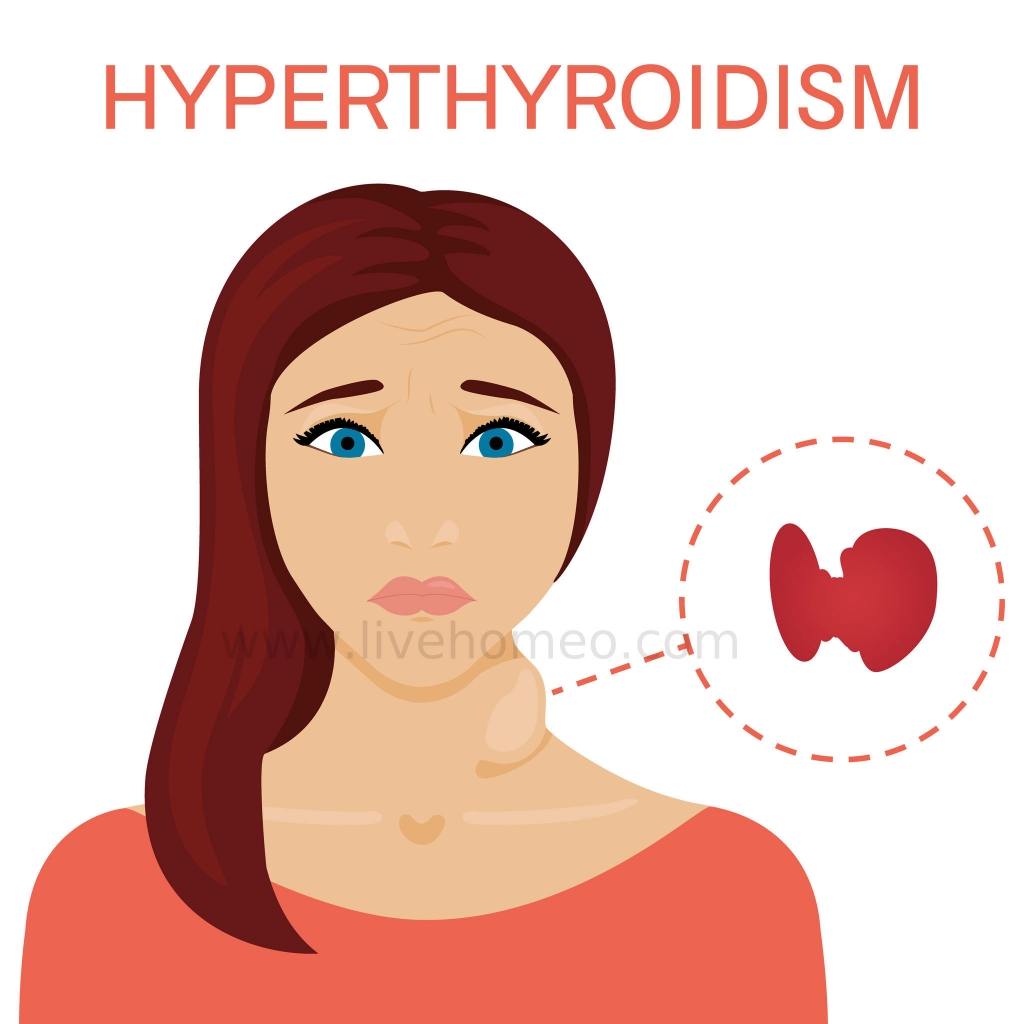 Tips to Overcome hyperthyroid Disorders