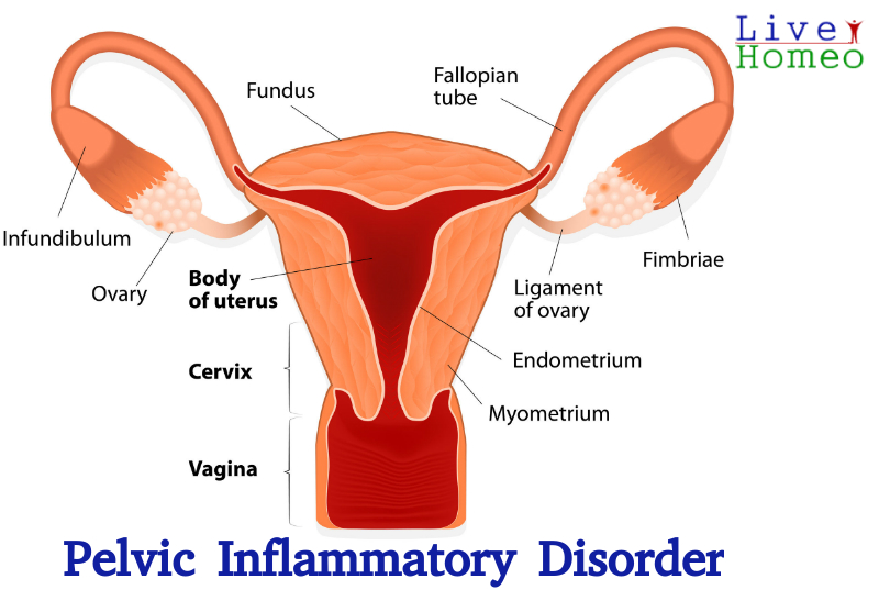 Pelvic Inflammatory Disorder