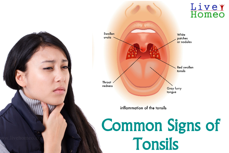 Signs of Tonsils
