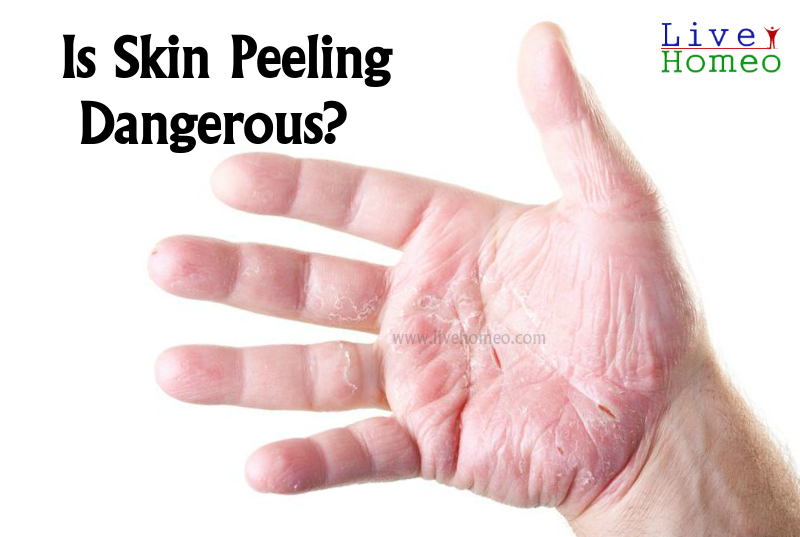 Peeling skin Causes