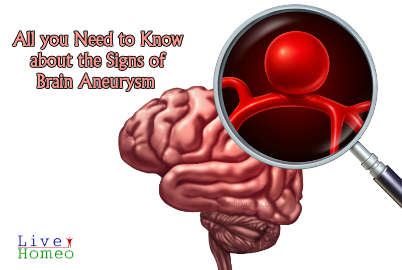 Signs of Brain Aneurysm