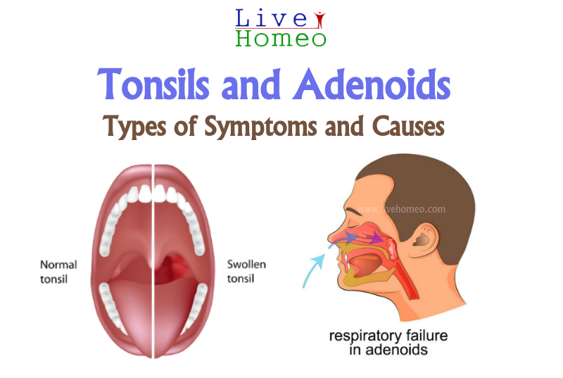 Tonsils and Adenoids