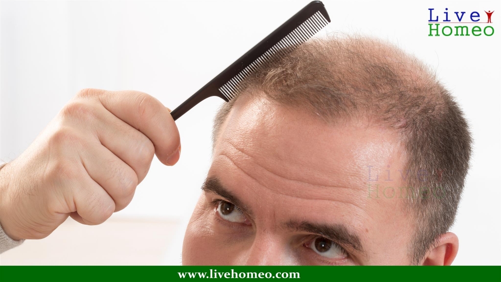 Hairloss Treatment in Homeopathy