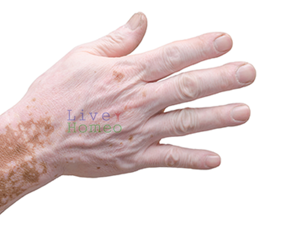 Vitiligo Treatment in Homeopathy