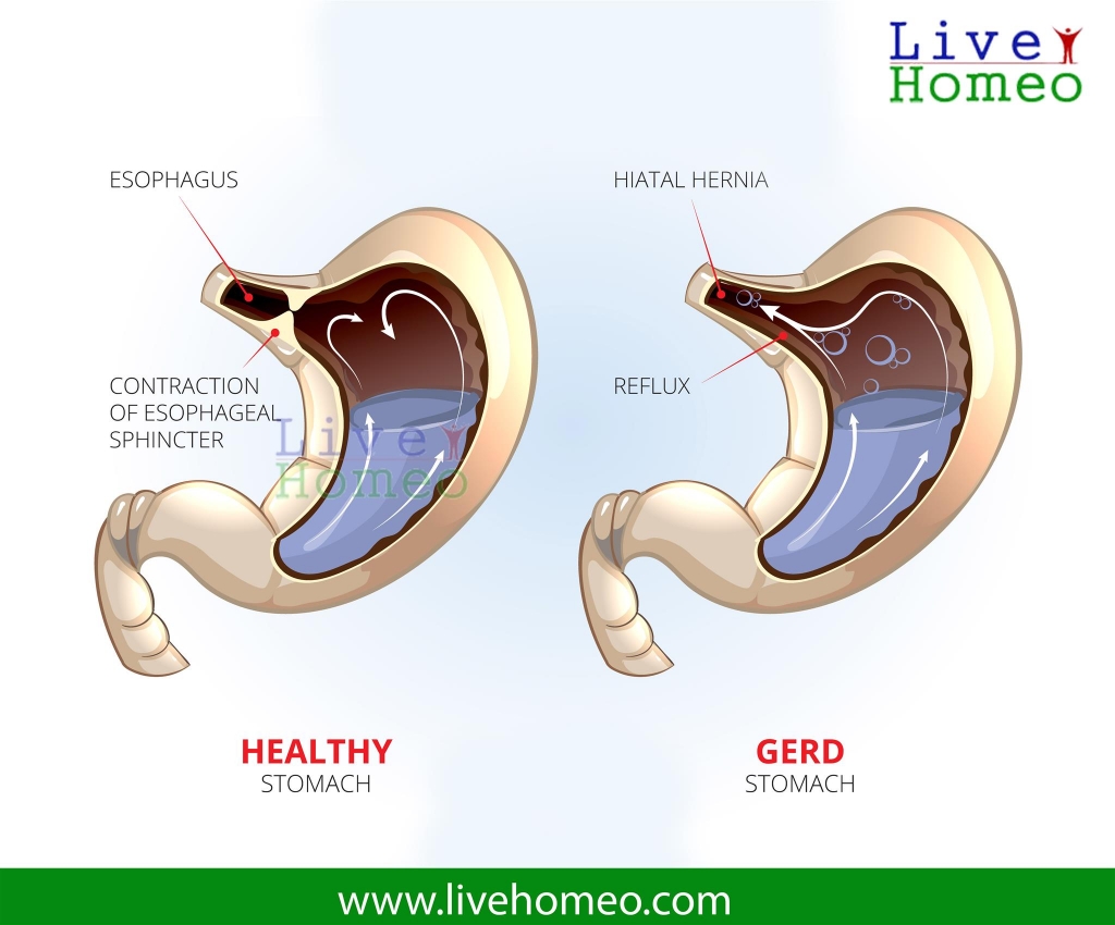Homeopathy Treatment for GERD