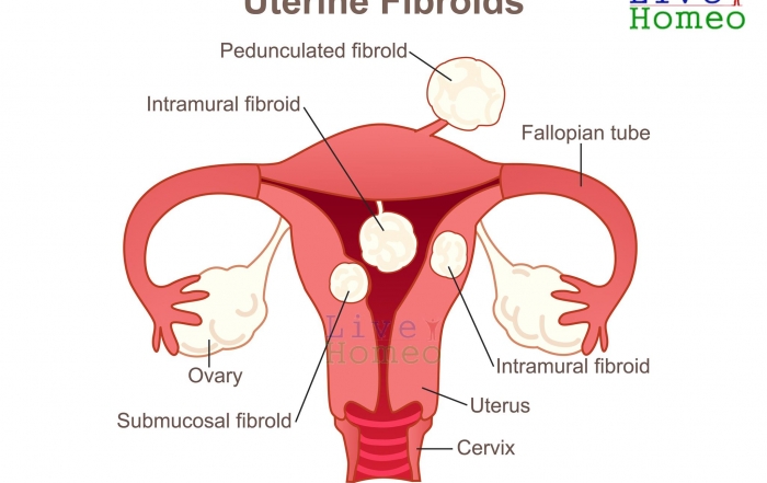 Homeopathy Treatment for Uterine Fibroids