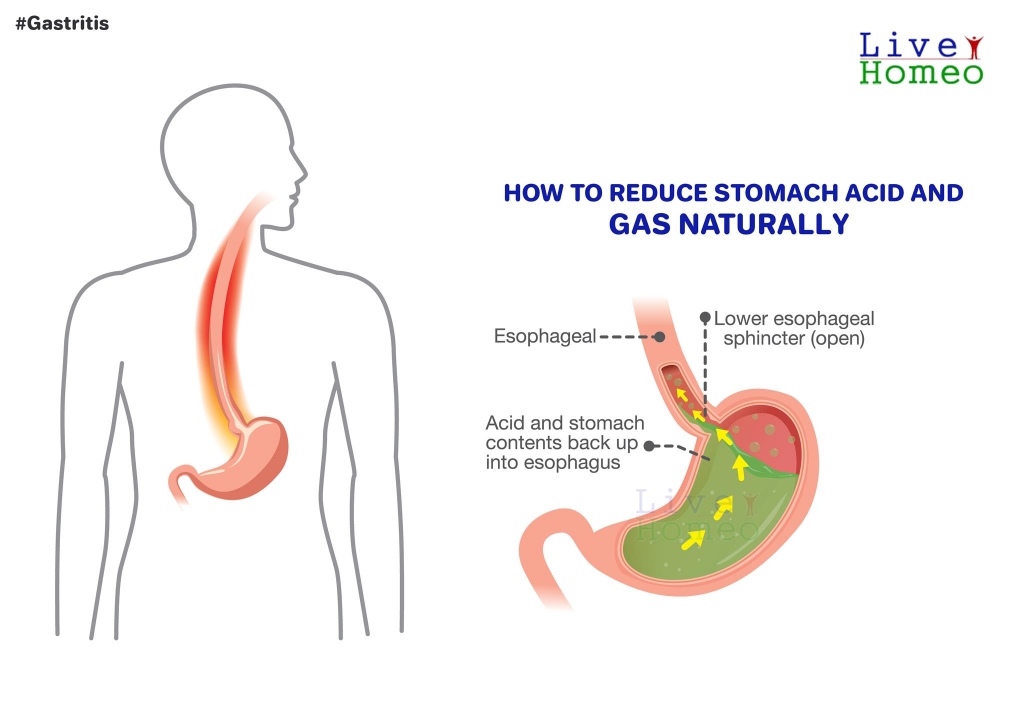 how to reduce stomach acid and gas naturally