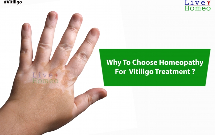 Why-to-choose-homeopathy-for-Vitiligo-treatment