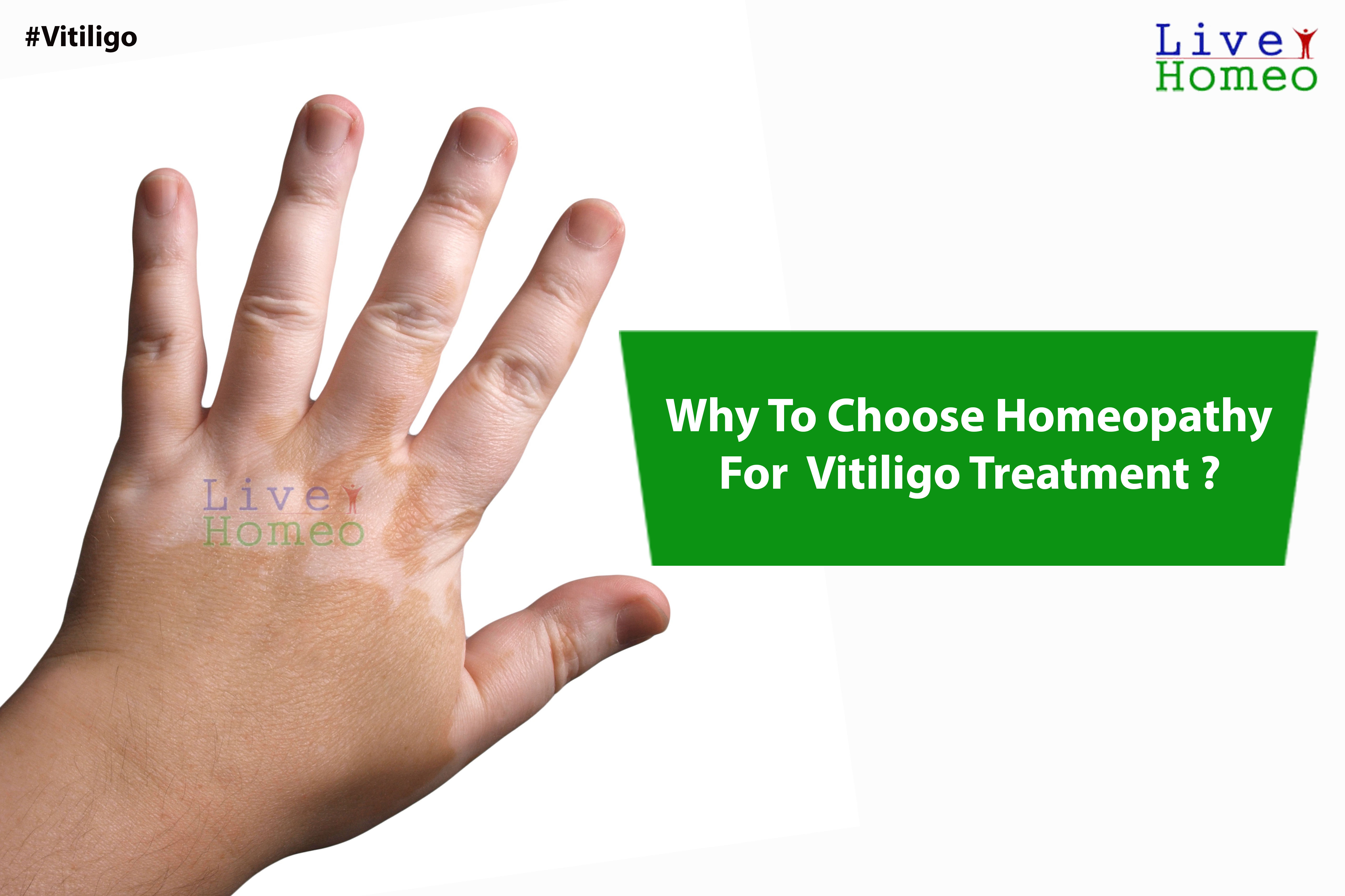 Why-to-choose-homeopathy-for-Vitiligo-treatment